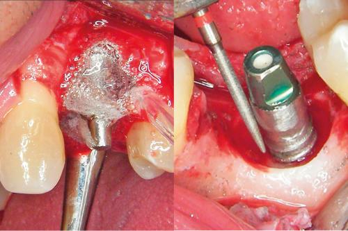 Periimplantitis